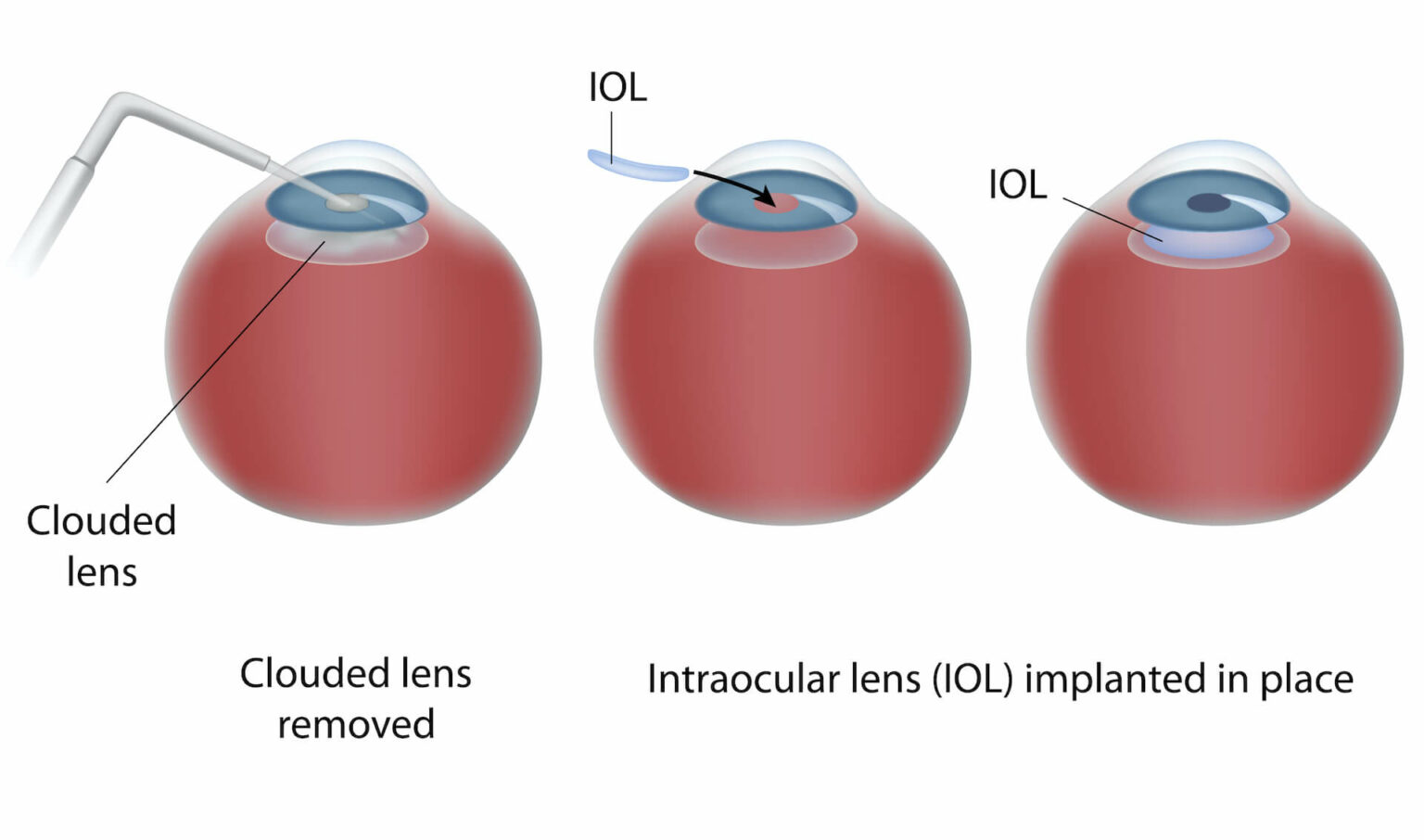 Cataract Surgery Stockton Laser Cataract Surgery Tracy Cataracts Lodi